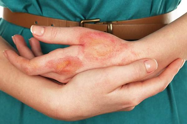 جراحی ترمیم سوختگی